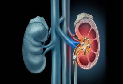 أربع طرق لإذابة حصى الكلى بشكل طبيعي