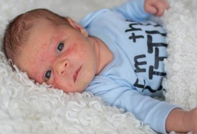 تعرفي على أهم أسباب ظهور الطفح الجلدى عند الأطفال