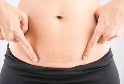 دراسة جديدة تكشف العلاقة بين العملية القيصرية والتطور النفسى للتوائم