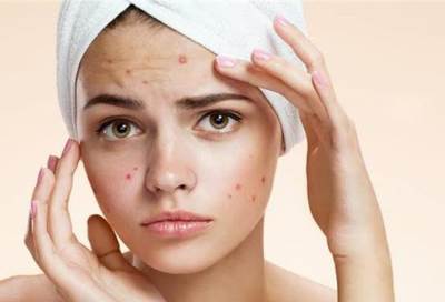 حب الشباب يرفع خطر الإصابة بالاكتئاب