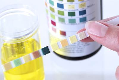 علماء يطورون اختبار بول يغير اللون للأزرق عند اكتشاف السرطان بالجسم