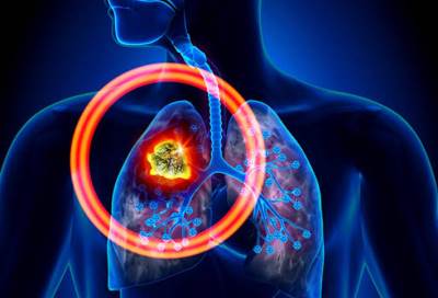 علامات تشير إلى إصابتك بسرطان الرئة .. تعرفي عليها