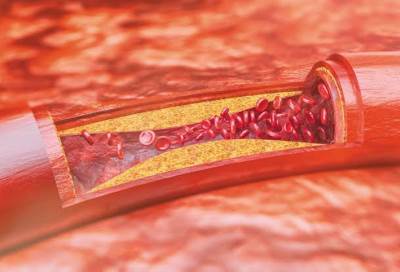 العلماء يكتشفون جين جديد مسئول عن الإصابة بتصلب الشرايين
