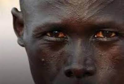 المرض الغامض في إثيوبيا .. إليكِ التفاصيل