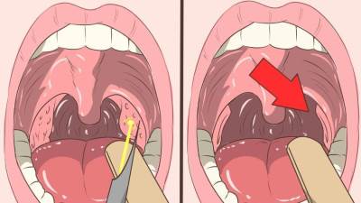 3 حيل سريعة للتخلص من التهاب اللوزتين في لمح البصر