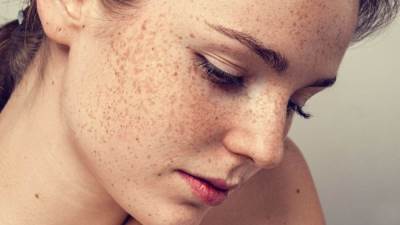دليل الجمال الصيفي: 5 علاجات طبيعية للنمش