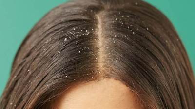 طرق سهلة للتغلب على قشرة الرأس خلال الصيف  