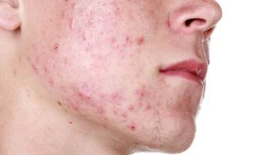 5 طرق طبيعية لمحاربة مشكلة حب الشباب لدى الرجال خلال الصيف