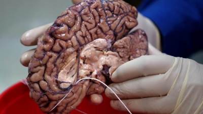 خبر سار .. علماء يتوصلون لأمل جديد فى الاكتشاف المبكر لأورام الدماغ