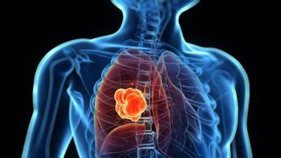 أعراض تحذيرية غير متوقعة لسرطان الرئة