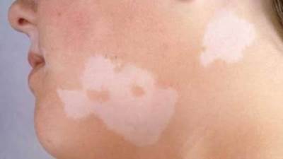 خطوات علاج البهاق بسهولة .. تعرفي عليها