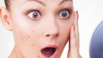 علاج حب الشباب نهائيًا .. إليكِ التفاصيل