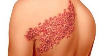 أسباب الحزام الناري وكيف يمكن علاجه؟