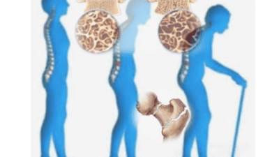 كيف تحمي نفسك من ترقق العظام؟