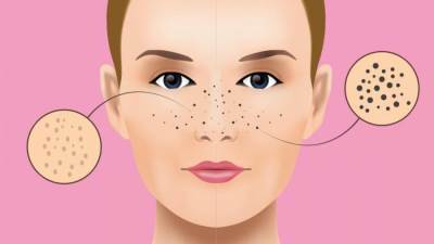 ماسك لازالة الرؤوس السوداء من أول مرة