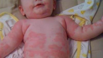 تعرفي على أعراض حساسية الألبان عند الأطفال