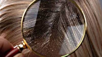 من مطبخك القضاء على قشرة الشعر فى دقائق