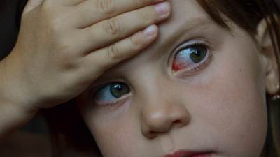 3 طرق مختلفة لعلاج حساسية العين عند الأطفال