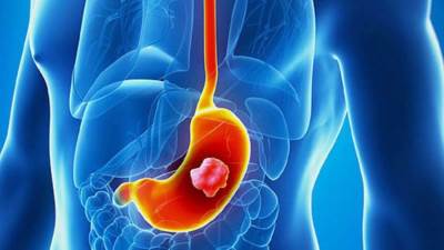 اعرف العلاقة بين سرطان الأمعاء وتناول المضادات الحيوية
