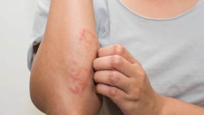 هل تعلمي أن الإكزيما مرض جلدي يؤثر في الصحة النفسية أيضاً؟