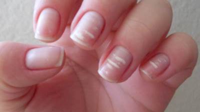 إنتبه .. ظهور هذه البقع على الأظافر مؤشر خطير