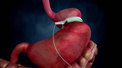 هل عملية تكميم المعدة لها مخاطر ؟ .. اعرف الحقيقة