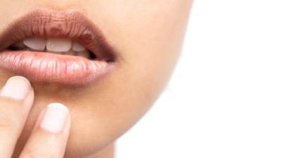 الصبار والشاي الأخضر.. أبرز مكونات لعلاج تشقق الشفاه