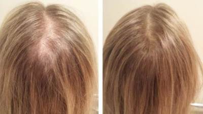 بشرى سارة.. عقار جديد يعيد نمو الشعر بالكامل