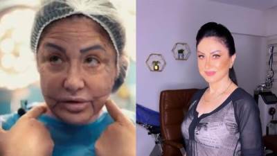 نتيجة عميل التجميل للفنانة وفاء سالم بعد أسبوع من الجراحة