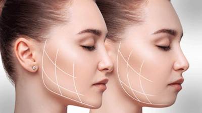 إزالة دهون الخدّين موضة رائجة في التجميل.. ما هي؟ وكيف تتم؟