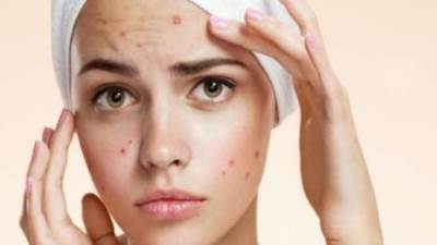 طرق فعالة تخلصك من حب الشباب سريعًا