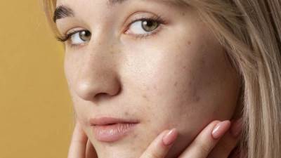 كيف تتخلّصين من البقع الداكنة بعد حبّ الشباب؟